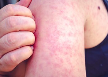 Kentucky’s measles outbreak continues to grow