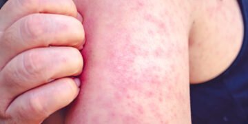 Kentucky’s measles outbreak continues to grow