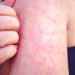 Kentucky’s measles outbreak continues to grow