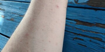 Henderson Manor residents say they deal with bedbugs, mice, violence and more
